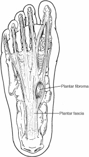Fibroma Fibroma