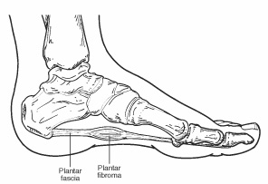 Fibroma2 Fibroma2