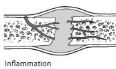 boneheal-inflamation