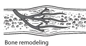 boneheal-remodeling
