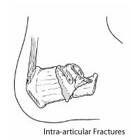 Calcan Fractures 1
