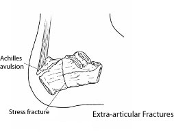 Calcan Fractures 2